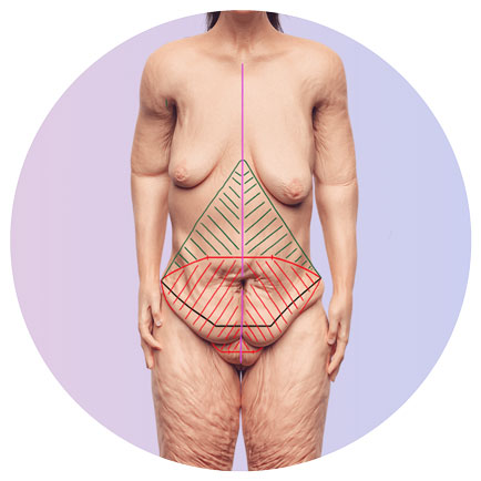 Hautstraffung am Bauch im Sinne eine Bauchdeckenstraffung - Abdominoplastik